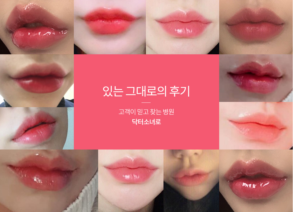 mo입술필러후기
